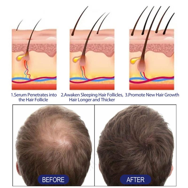 Fibres Capillaires pour la Perte de Cheveux