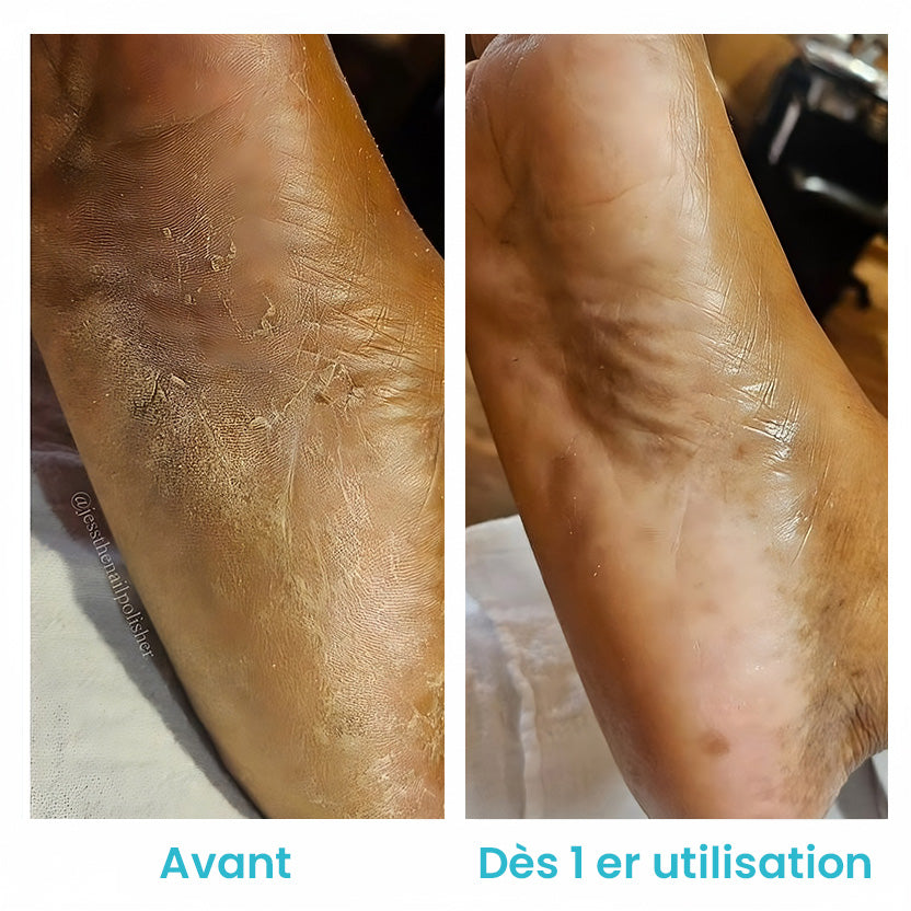 Lotion exfoliante zurie