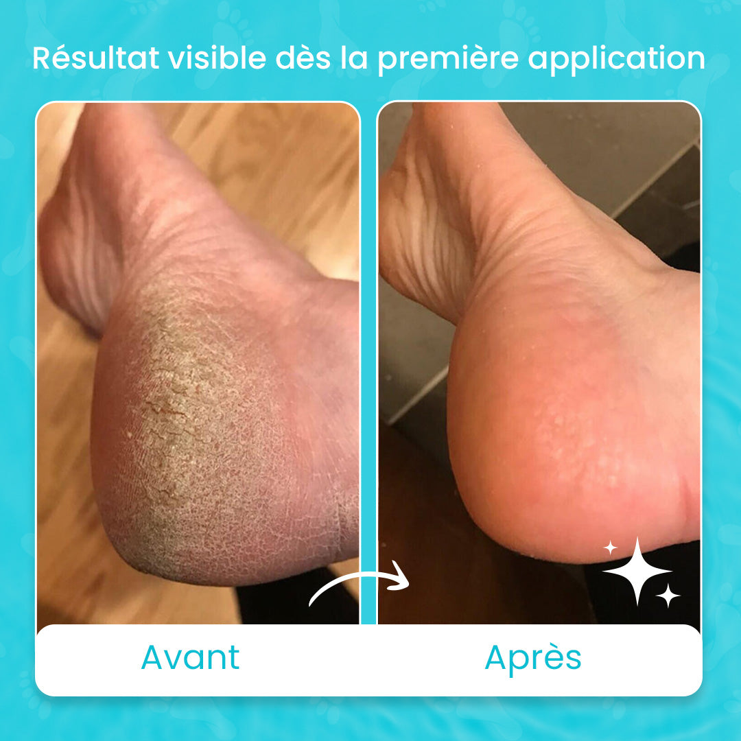 Lotion exfoliante zurie