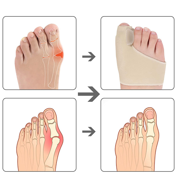 Support d'Orteil pour Correction d'Hallux Valgus