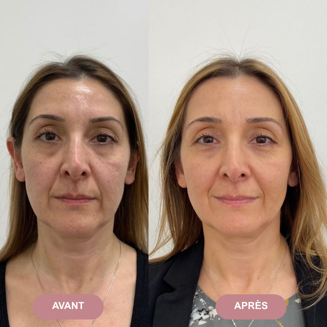 GlowSculpt 7 - Sculpteur visage LED 7-en-1