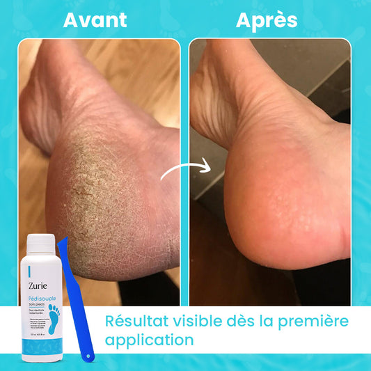 Lotion exfoliante zurie