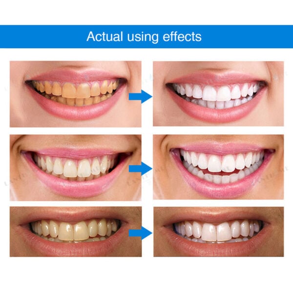 blanchiment des dents