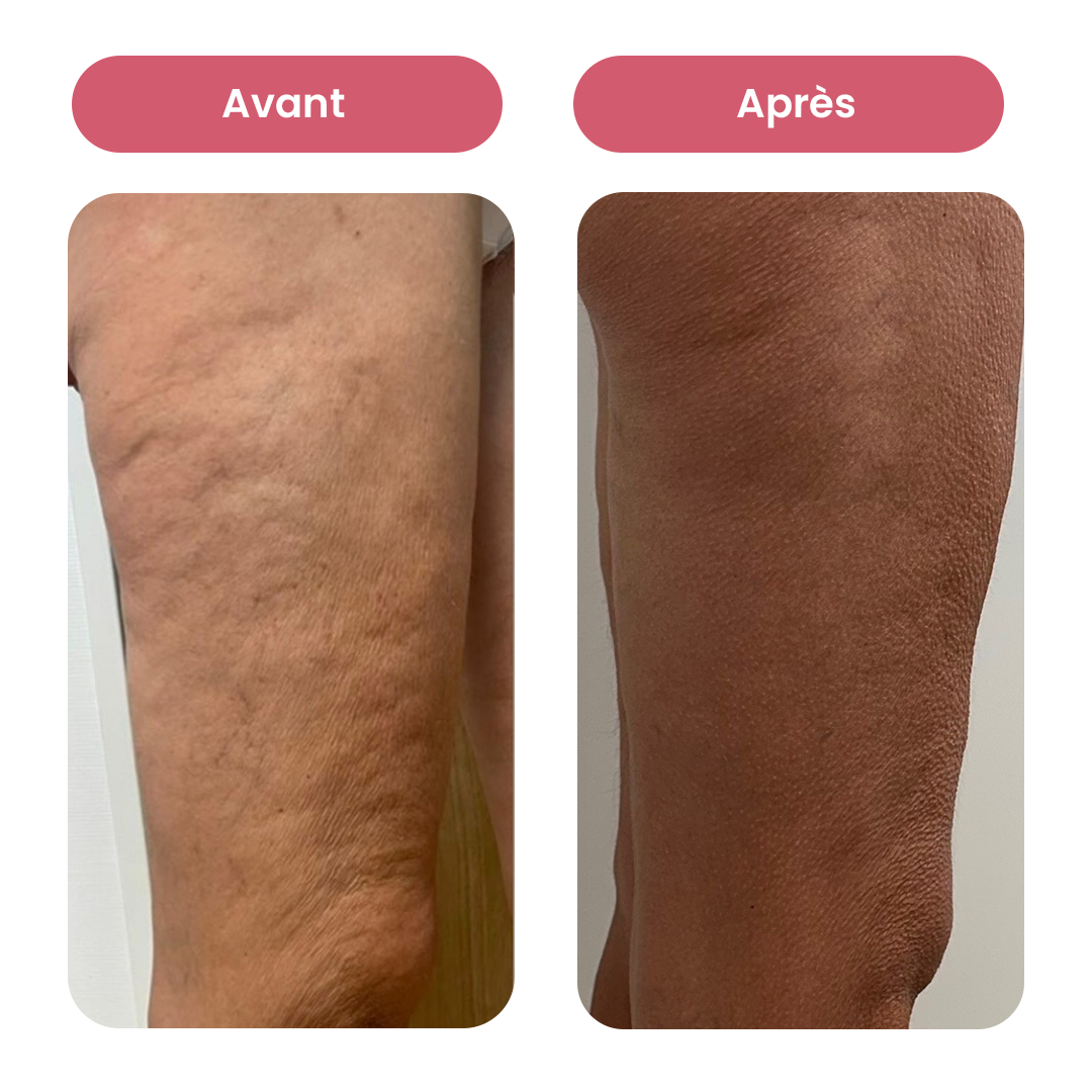 Masseur Anti-Cellulite Électrique