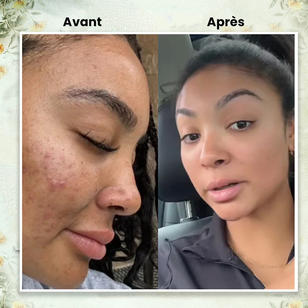 Baume au Suif tout -en-1 – Anti-acné, anti-rides, hydratation longue durée