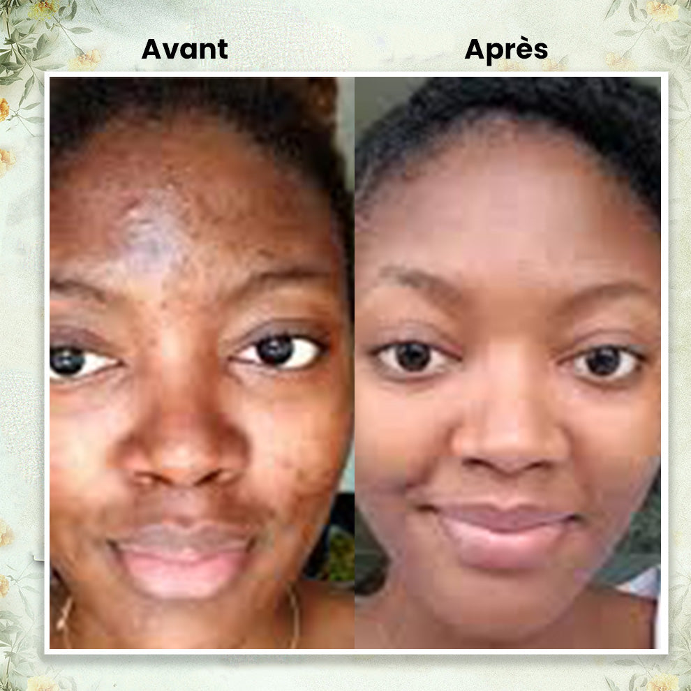 Baume au Suif tout -en-1 – Anti-acné, anti-rides, hydratation longue durée