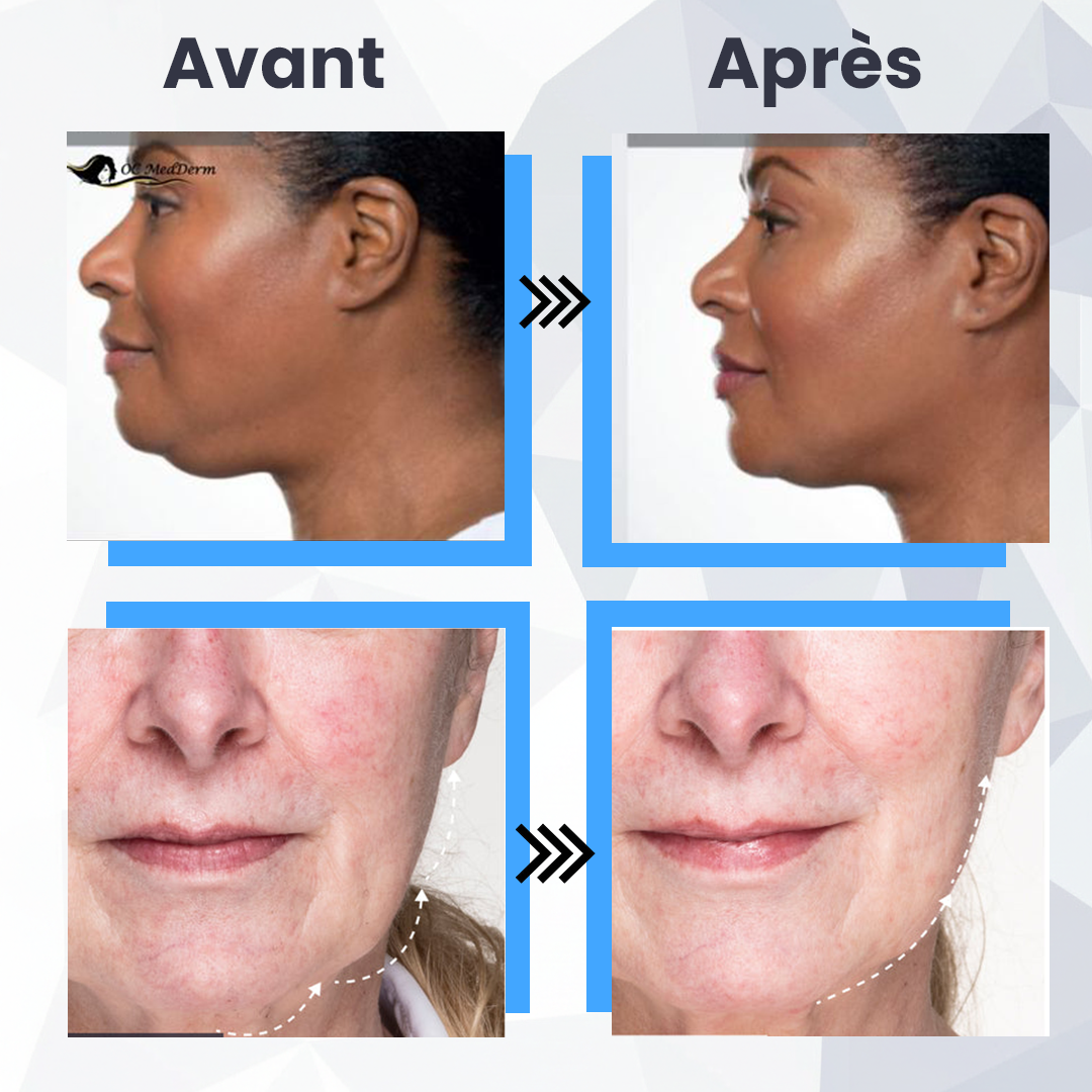 Masque Lift Essential EMS Medi - Soin du Visage EMS à Domicile