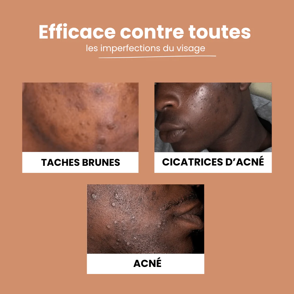Pads Curcuma Anti-Taches – Peaux Noires & Métissées